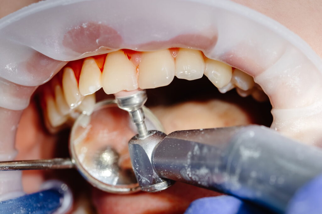 Dental Scaling and Polishing in Doha