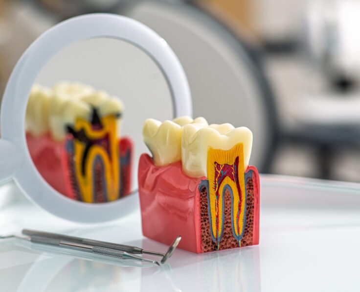 Root Canal Treatment in Doha, Qatar