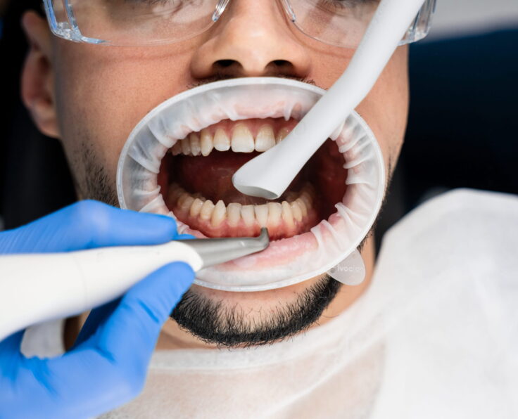 Teeth Cleaning By Turkish Hospital
