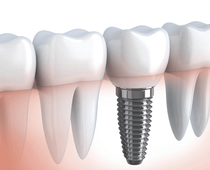 implant